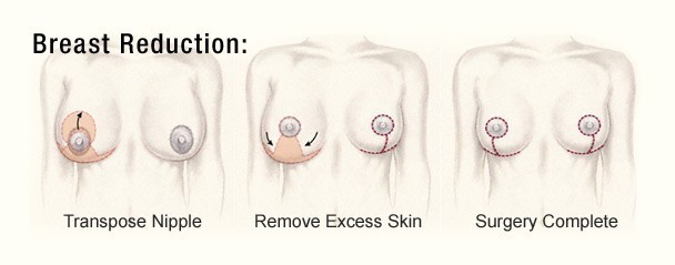 breast-reduction-diagram-2