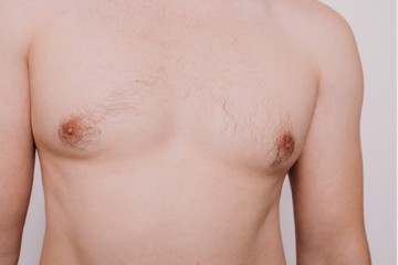 <span class='p-name'>Male Breast Reduction (Gynecomastia)</span>