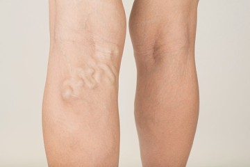 <span class='p-name'>Ultrasound-guided foam sclerotherapy</span>